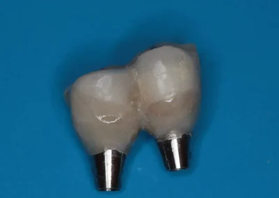 coronas de porcelana o zirconio con base metálica para atornillar sobre los implantes instalados en la boca, las cuales se realizan en SVG Clínica Dental