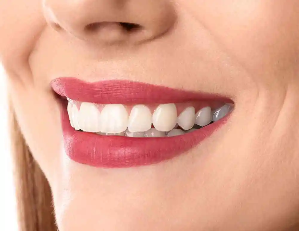 Paciente joven con linda sonrisa, con los dientes mas claros, mas blancos después del blanqueamiento dental en clínica