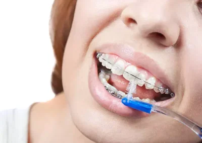En SVG Clínica Dental se educa en el uso del cepillo interproximal para la higiene de la paciente que usa brackets de ortodoncia. La paciente está limpiando sus dientes que tienen ortodoncia cerámica instalada, para complementar su higiene.