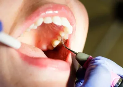 Limpieza dental profesional con ultrasonido. Se observa la punta del instrumento que usa el dentista de SVG Clínica Dental para hacer el procedimiento.