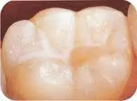 Molar sano con surcos masticatorios oclusales bloqueados por sellante de fotocurado. Este tratamiento se realiza en SVG Clínica Dental