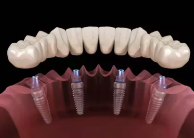 Prótesis mandibular Sistema All on four soportado por implantes. Ilustración 3D del concepto de dentaduras postizas y dientes. Se instalan 4 o 5 implantes para soportar una prótesis que reemplazan la arada de los dientes superiores.