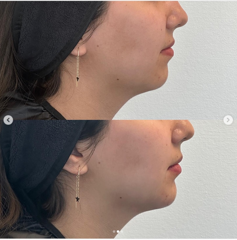 Aumento de mentón y armonización facial en SVG Clínica Dental
